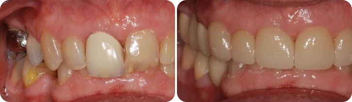Dental Implant case studies image 2